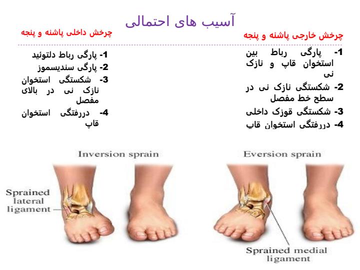 پاورپوینت آسیب های مچ پا و پا 