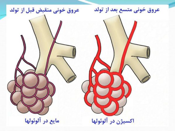 روش های حمایت تنفسی در نوزادان نارس