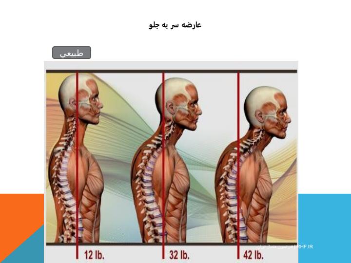 عارضه-سر-به-جلو-حركات-اصلاحي-و-درماني1