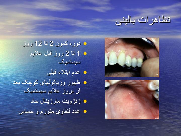 آفت-و-هر-پس-و-تشخیص-افتراقی-و-درمان4