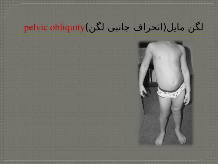 انحراف-جانبی-لگن1