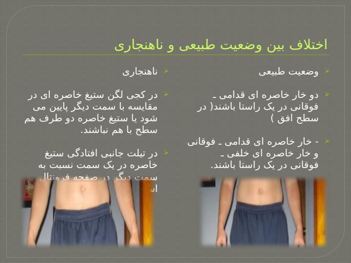 انحراف-جانبی-لگن3