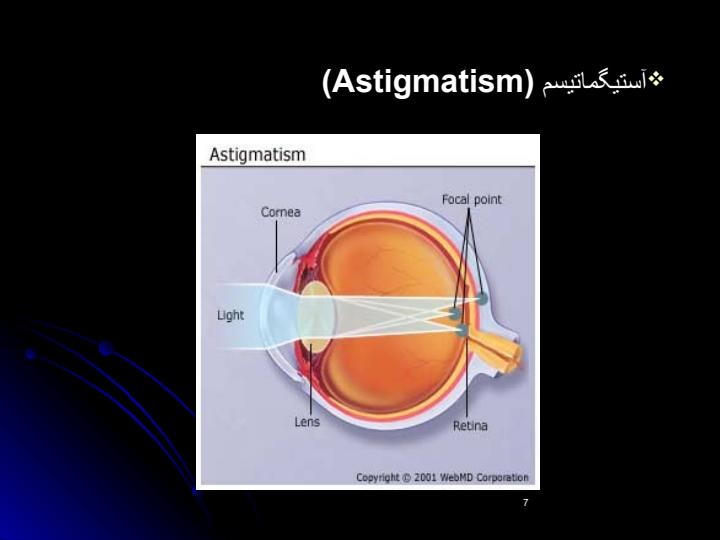 ليزر-و-اصلاح-عيوب-انكساري6