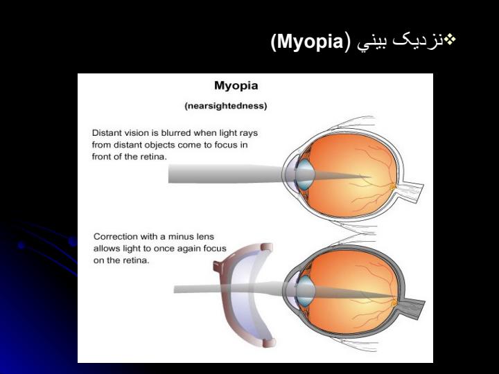 لیزر-و-اصلاح-عيوب-انكساري-ليزر4