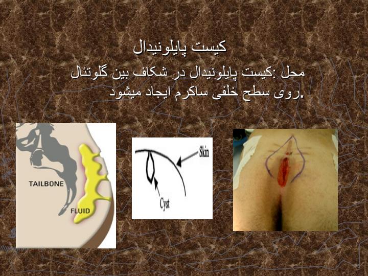 کیست-پایلونیدال1