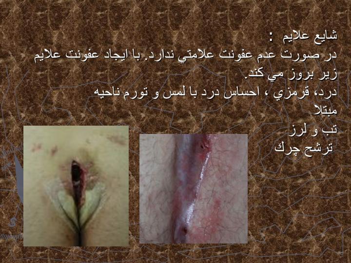 کیست-پایلونیدال4