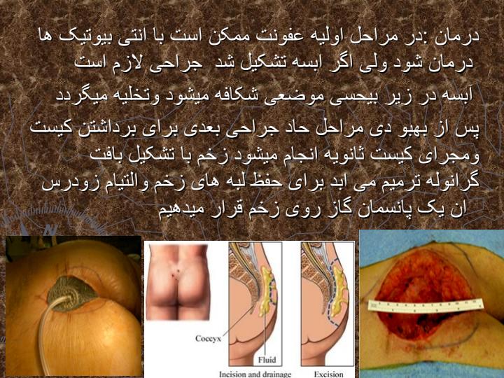 کیست-پایلونیدال6