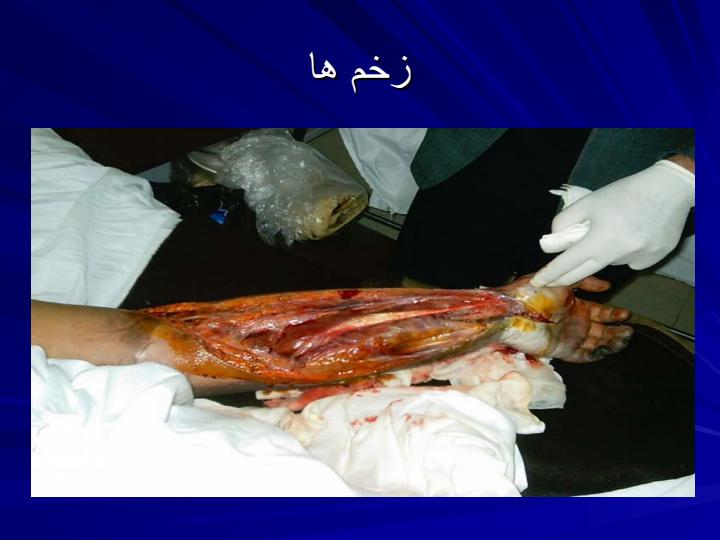 زخم-ها1