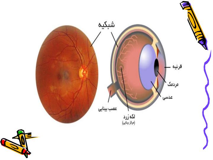 رتینوپاتی-نارس3