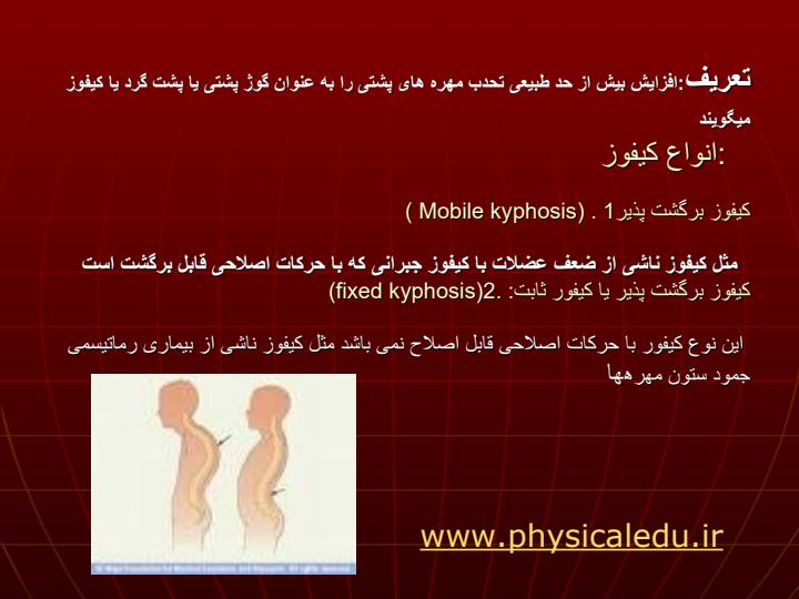 موضوع-تحقیق-پشت-گرد-کیفوز-پشتیKYPHOSIS2