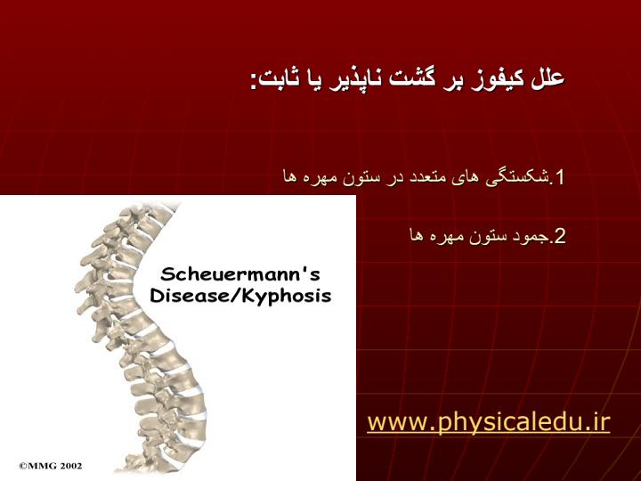 موضوع-تحقیق-پشت-گرد-کیفوز-پشتیKYPHOSIS4