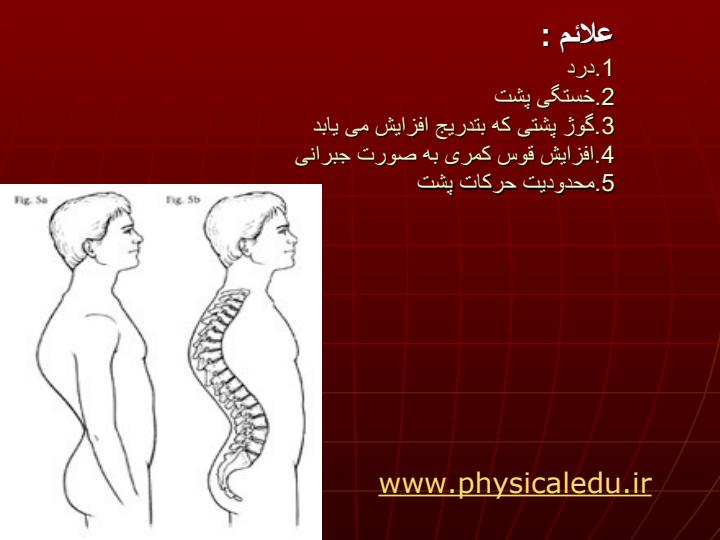موضوع-تحقیق-پشت-گرد-کیفوز-پشتیKYPHOSIS5