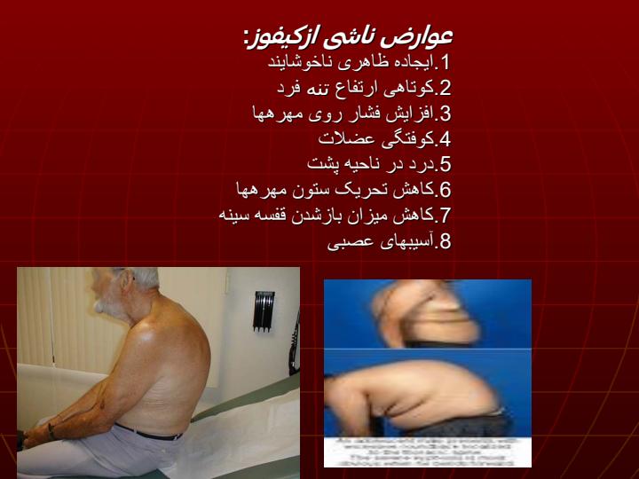 موضوع-تحقیق-پشت-گرد-کیفوز-پشتیKYPHOSIS6