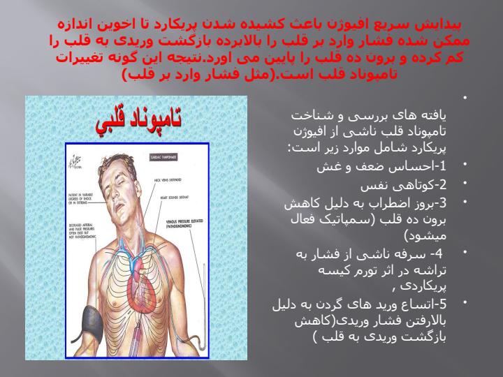 افیوژن-پریکارد-و-تامپوناد-قلبی4