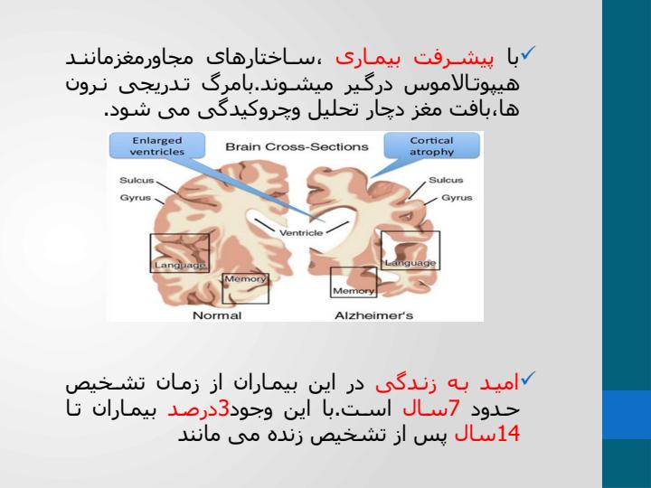 بیماری-آلزایمر6