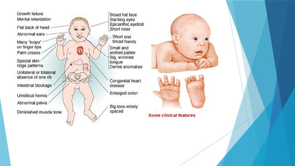 بیماری-ها-و-سندرم-های-ژنتیکی4