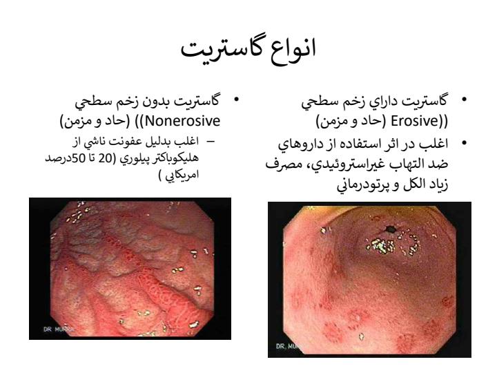 بیماری-گاستريت4