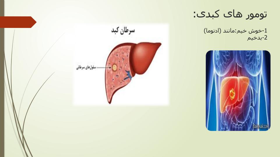 سرطان-کبد2