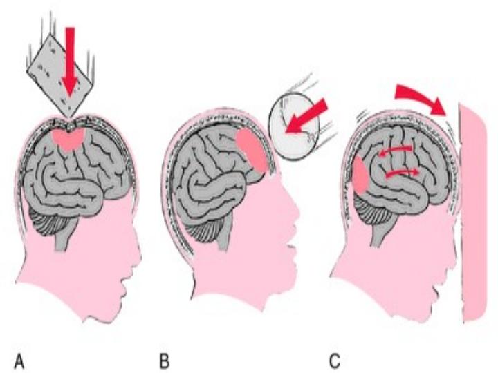 ضرزبه-به-سر-از-دیدگاه-پزشکی2