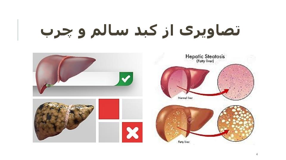 علت-و-درمان-بیماری-کبد-چرب3