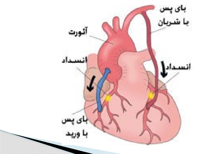 پیوند-عروق-قلبی2